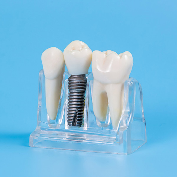 Featured image for “Dental Implants”