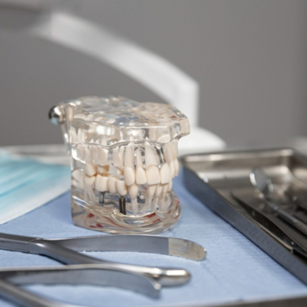 Featured image for “When to Choose All-On-4 Implants”