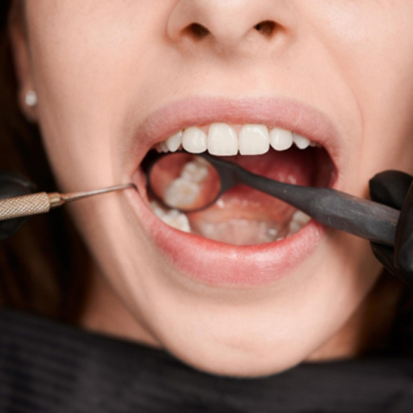 Featured image for “When to Consider Dental Bonding for a Beautiful Smile”