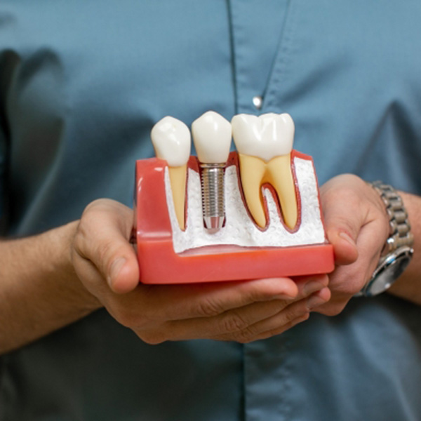 Featured image for “What Advantages Do All-On-X Dental Implants Offer?”