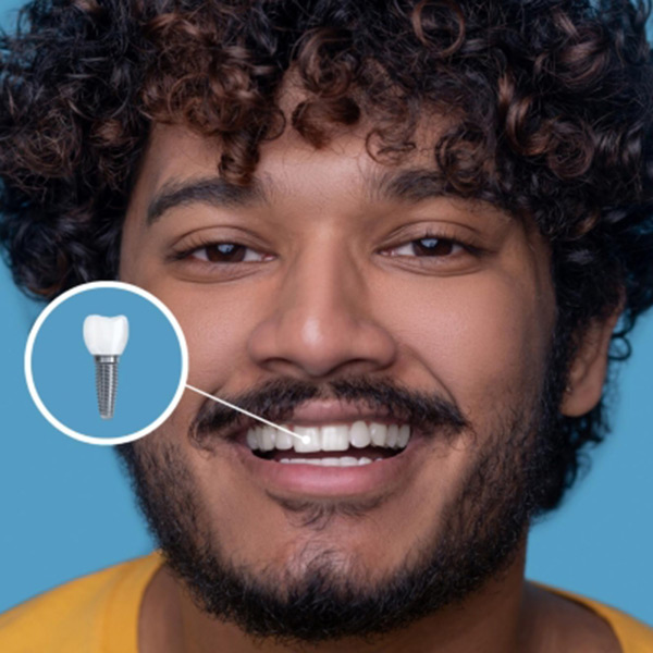 Featured image for “Smart Dental Implants Are the Future of Digital Monitoring”