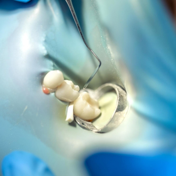 Featured image for “When You Might Need Inlays or Onlays for Your Teeth”