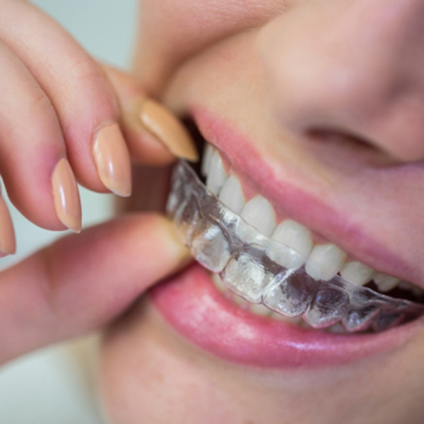 Featured image for “When Should You Remove Invisalign During Your Daily Routine?”