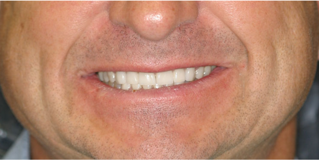 After dental treatment