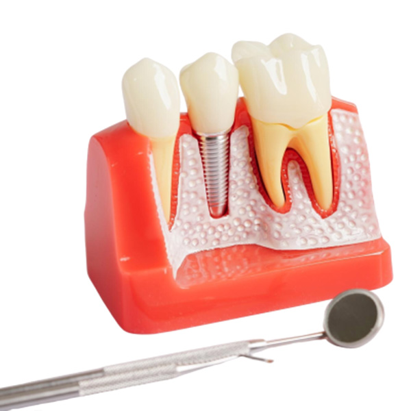 Featured image for “What Are Biologically Active Dental Implant Surfaces?”