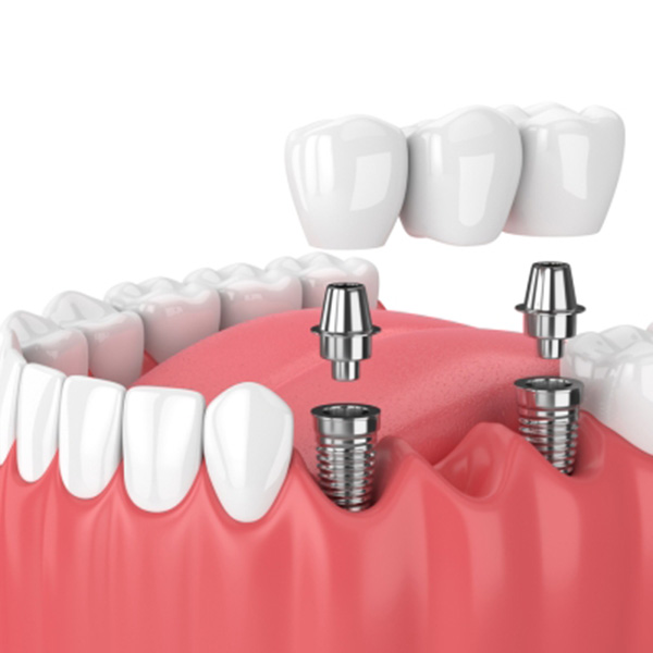Featured image for “6 Benefits of Getting a Porcelain Bridge”