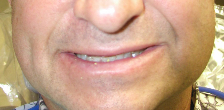 Smile makeover treatment