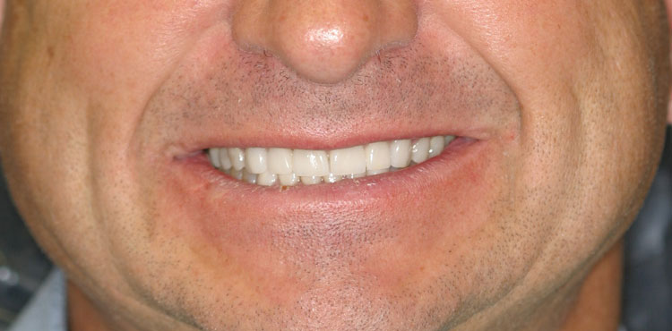 Smile makeover treatment