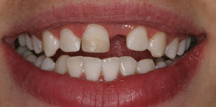 Smile makeover treatment
