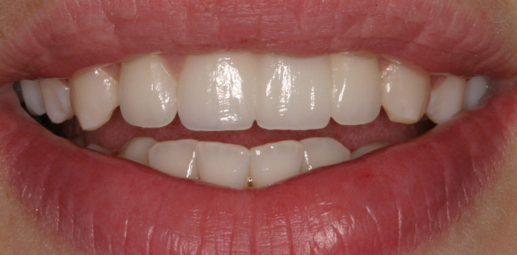 Smile makeover treatment