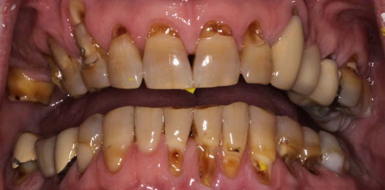Smile makeover treatment