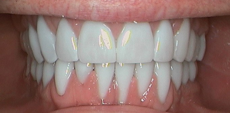 Smile makeover treatment