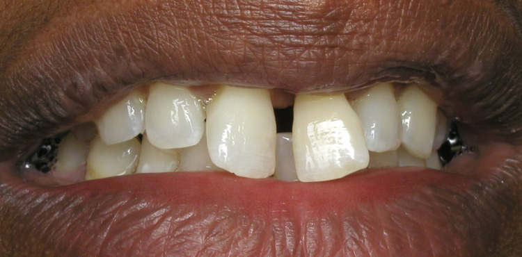 Smile makeover treatment