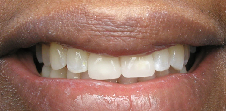 Smile makeover treatment