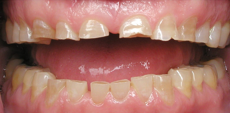 Smile makeover treatment