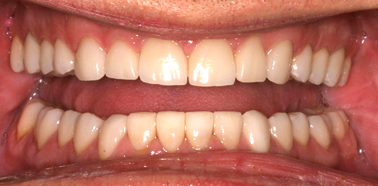 Smile makeover treatment