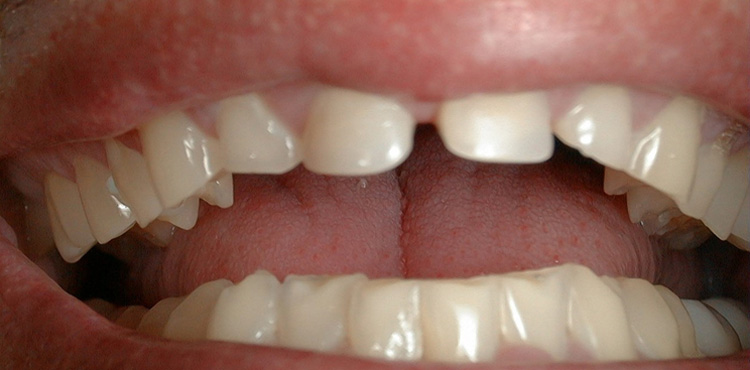 Smile makeover treatment