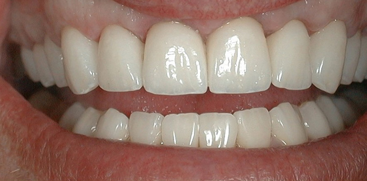 Smile makeover treatment