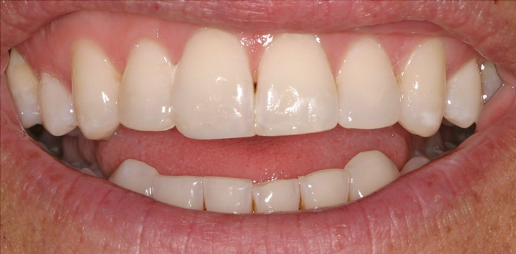 Veneers treatment