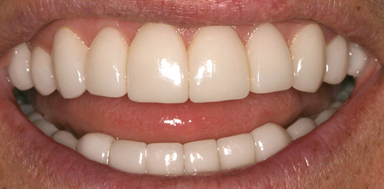 Veneers treatment