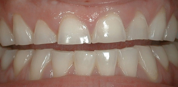 Veneers treatment