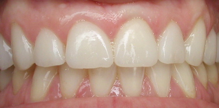 Veneers treatment