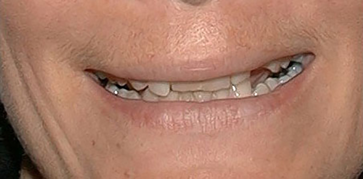 Veneers treatment