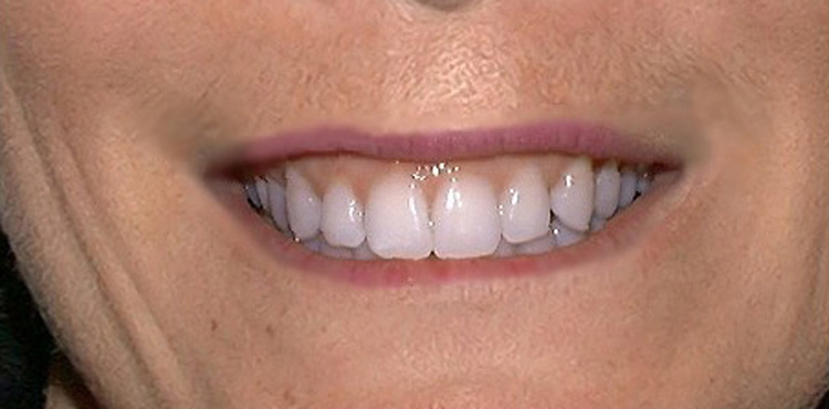 Veneers treatment