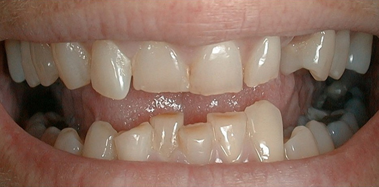 Veneers treatment