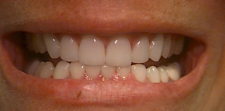 Veneers treatment